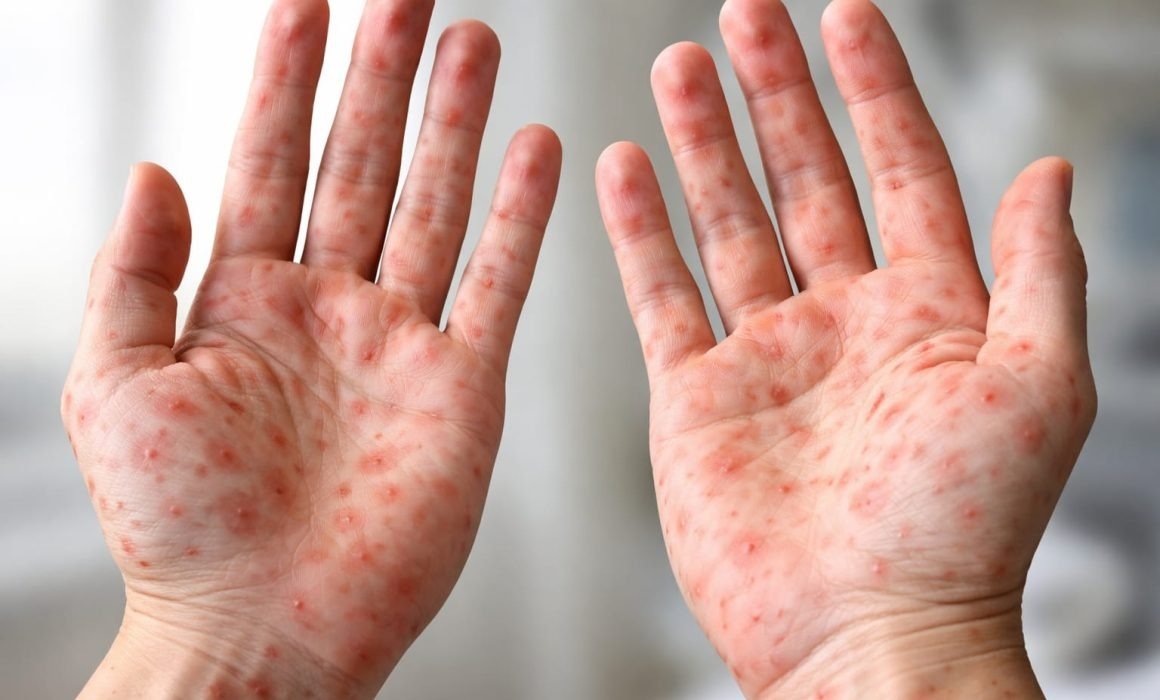 Aumentan casos de sarampión en todo Puebla